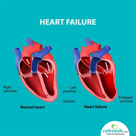 lv systolic pump function atrial fubrillation|Left Ventricular Systolic Dysfunction Due to Atrial Fibrillation .